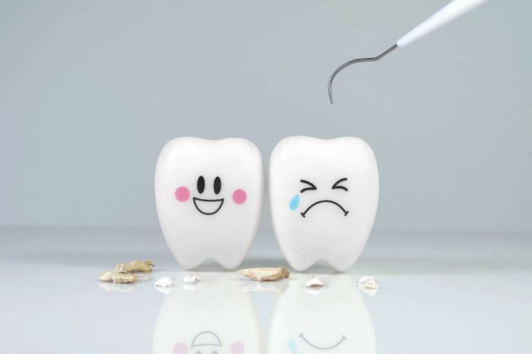 Remoção de tártaro nos dentes