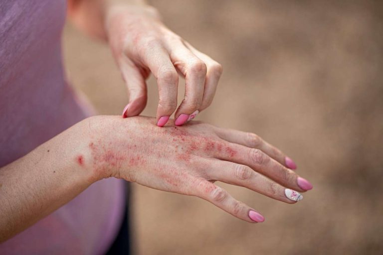 mulher coçando a mão com manchas vermelhas na pele, sinais de dermatite