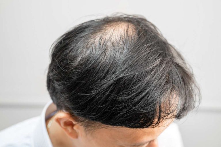 homem com falha de cabelo no topo da cabeça sinal de calvície masculina